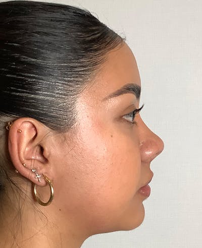Revision Rhinoplasty Before & After Gallery - Patient 211946 - Image 2