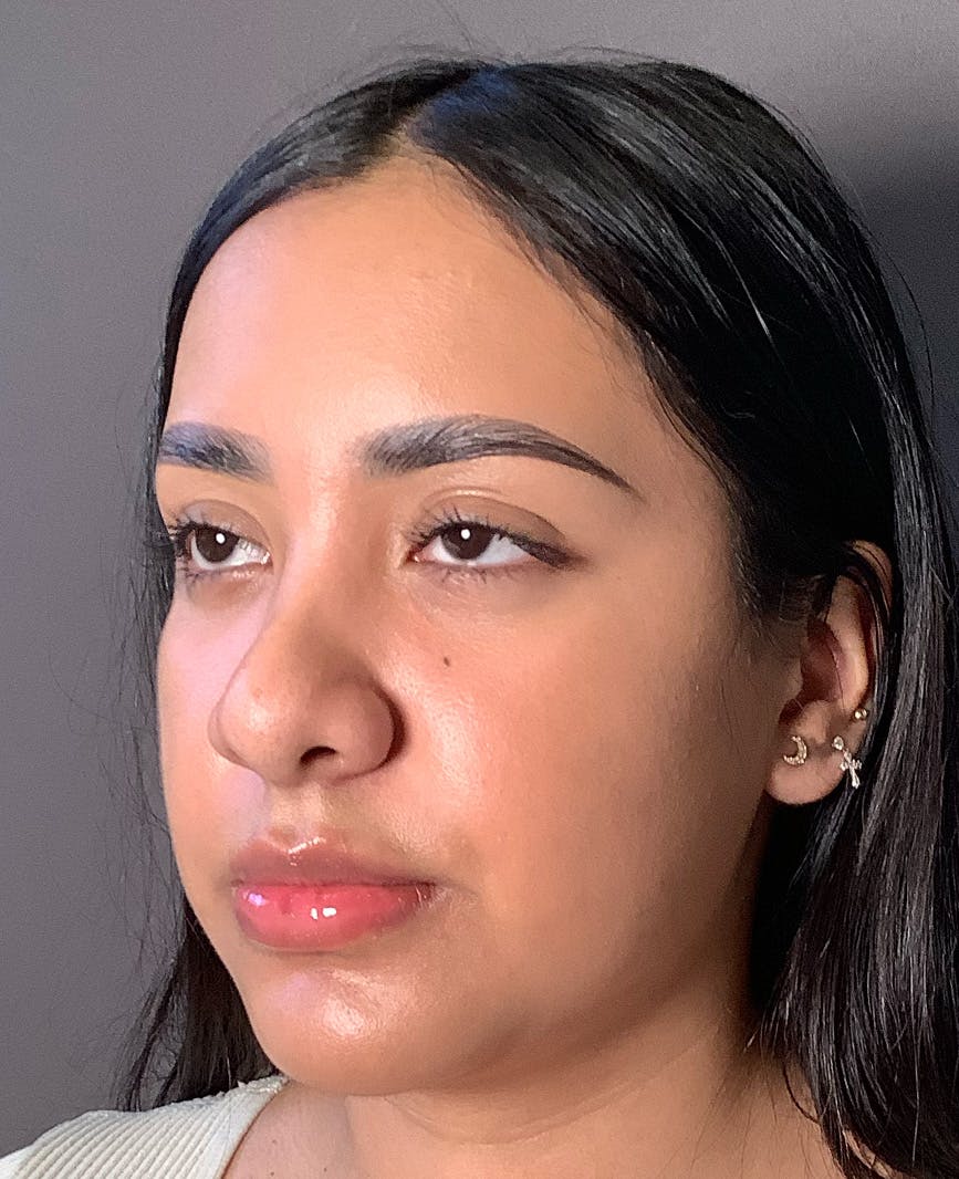 Revision Rhinoplasty Before & After Gallery - Patient 211946 - Image 7
