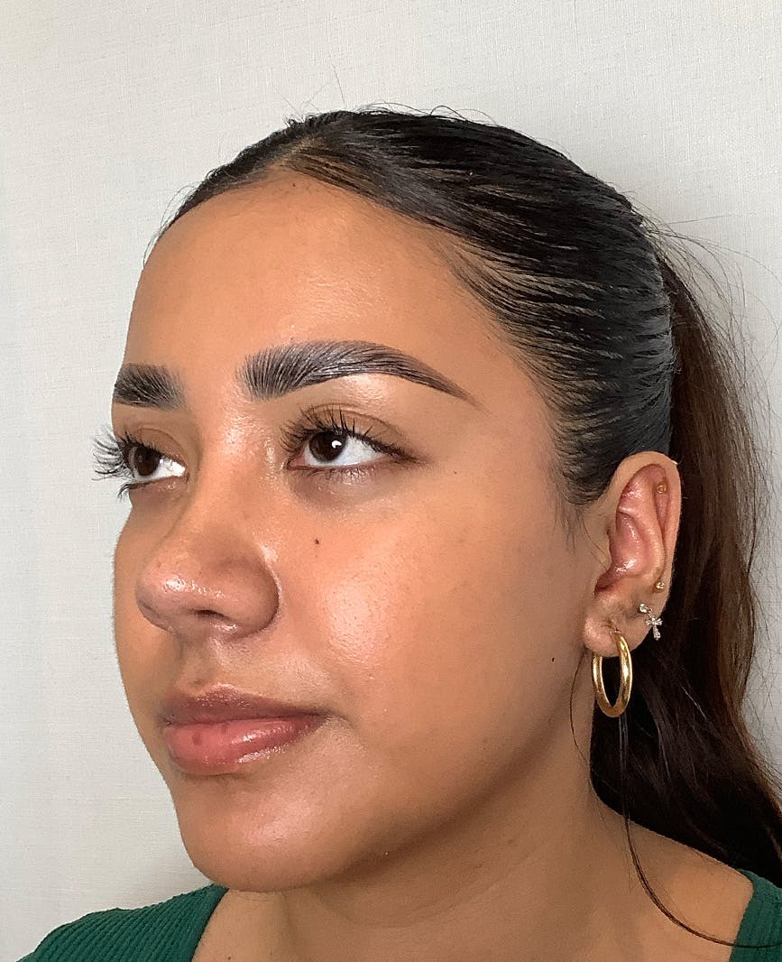 Revision Rhinoplasty Before & After Gallery - Patient 211946 - Image 8