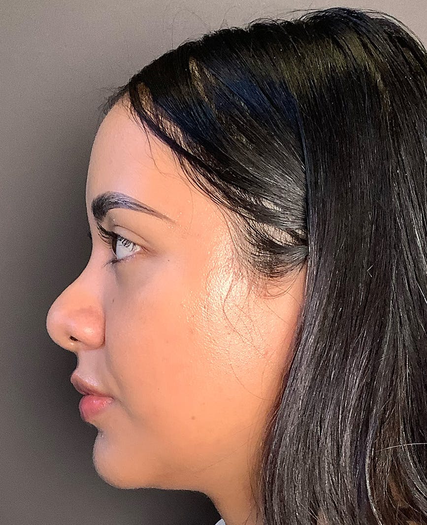 Revision Rhinoplasty Before & After Gallery - Patient 211946 - Image 9