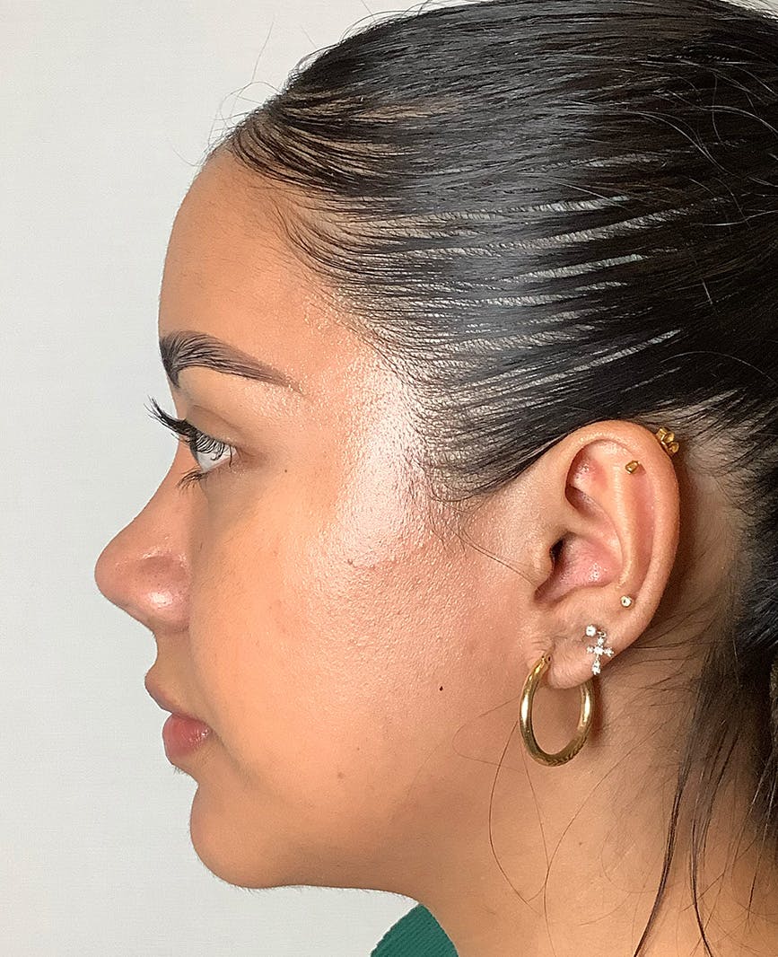 Revision Rhinoplasty Before & After Gallery - Patient 211946 - Image 10