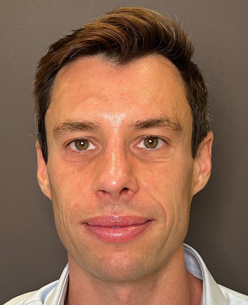 Rhinoplasty Before & After Gallery - Patient 518713 - Image 4