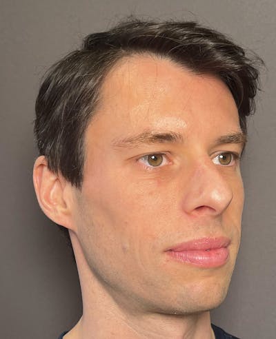 Rhinoplasty Before & After Gallery - Patient 518713 - Image 1