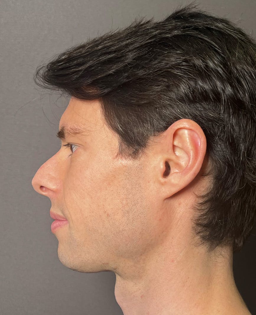 Rhinoplasty Before & After Gallery - Patient 518713 - Image 7