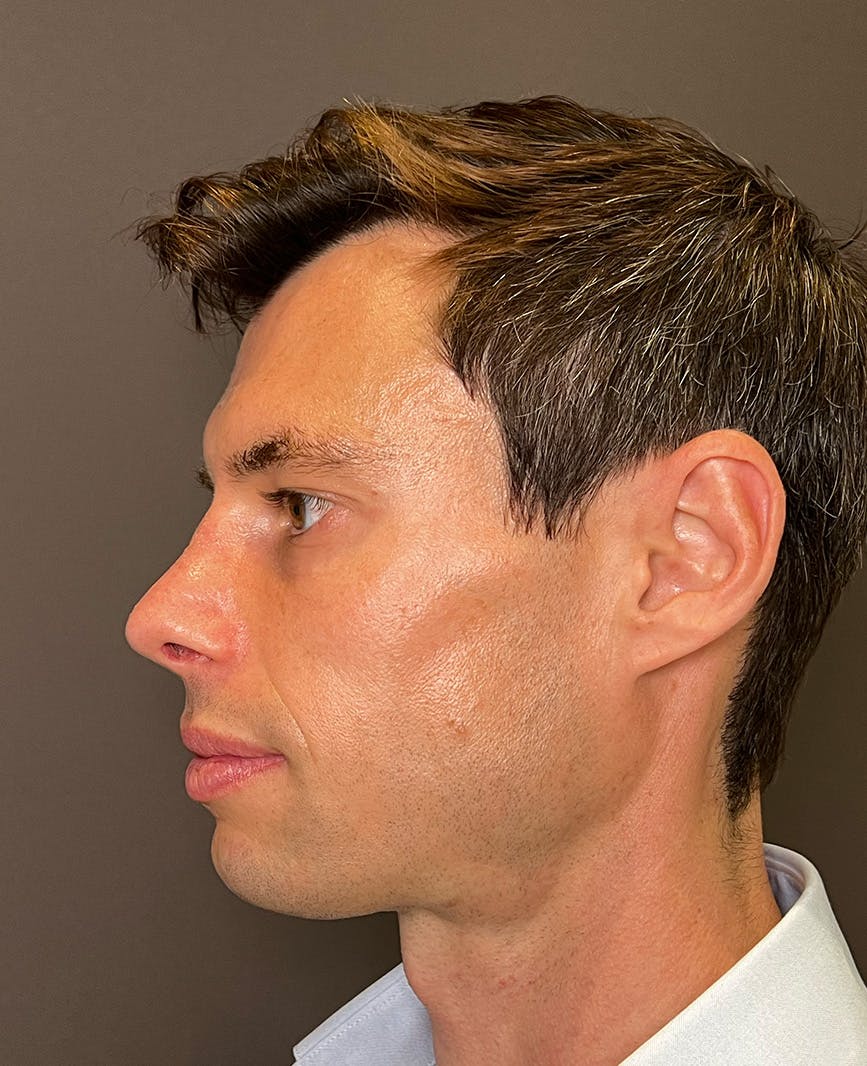 Rhinoplasty Before & After Gallery - Patient 518713 - Image 8