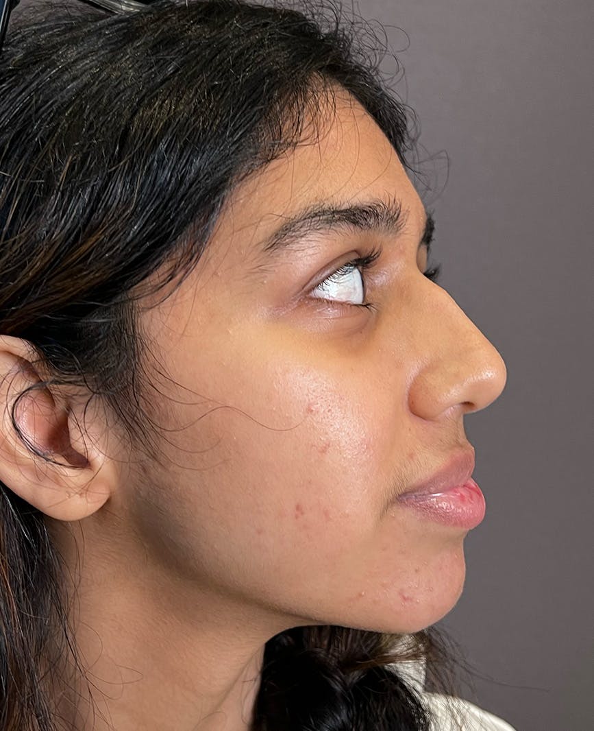 Rhinoplasty Before & After Gallery - Patient 342911 - Image 1