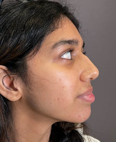 Rhinoplasty Before & After Gallery - Patient 342911 - Image 1