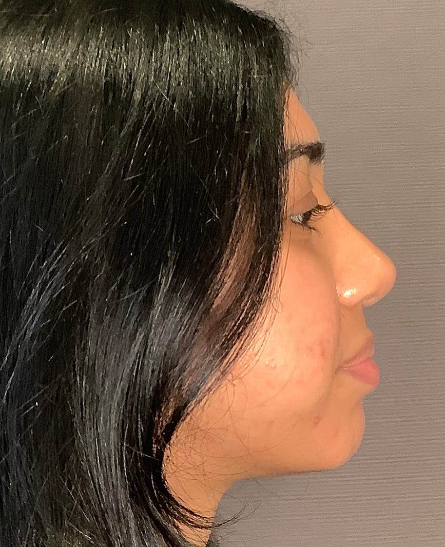 Rhinoplasty Before & After Gallery - Patient 342911 - Image 2