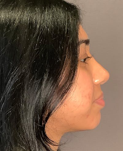 Rhinoplasty Before & After Gallery - Patient 342911 - Image 2
