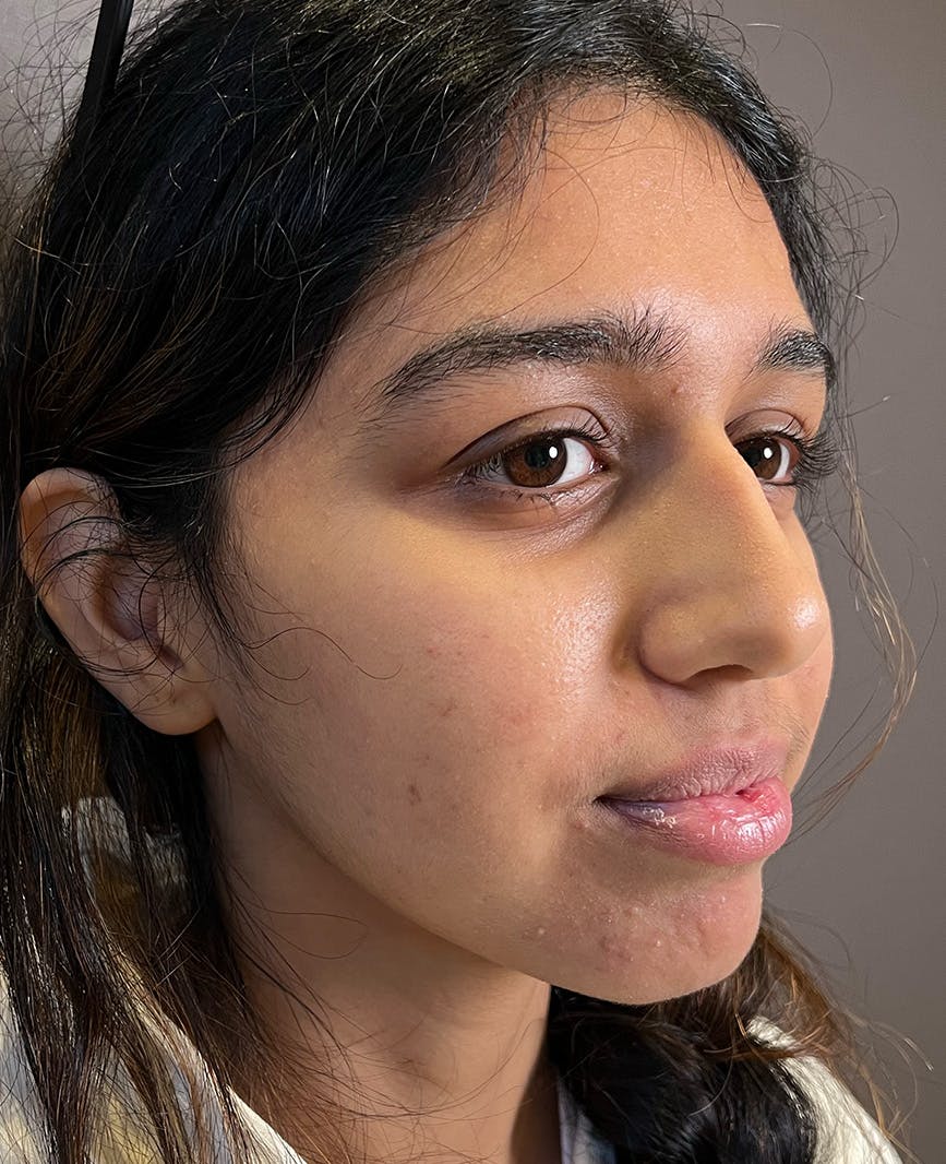 Rhinoplasty Before & After Gallery - Patient 342911 - Image 3