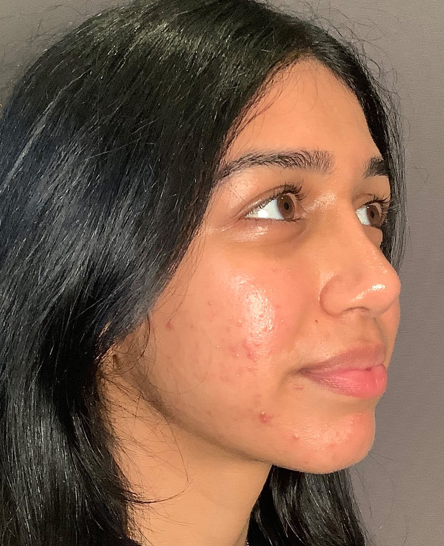 Rhinoplasty Before & After Gallery - Patient 342911 - Image 4