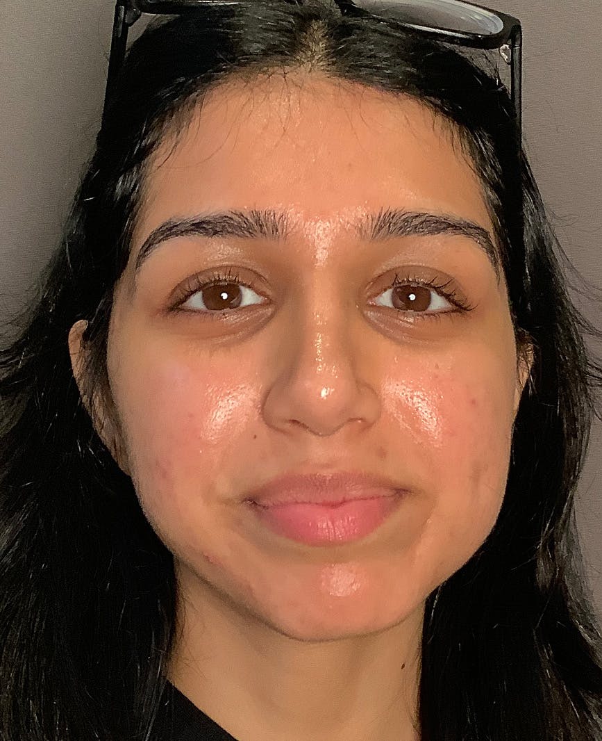 Rhinoplasty Before & After Gallery - Patient 342911 - Image 6