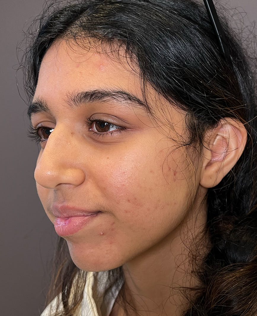 Rhinoplasty Before & After Gallery - Patient 342911 - Image 9