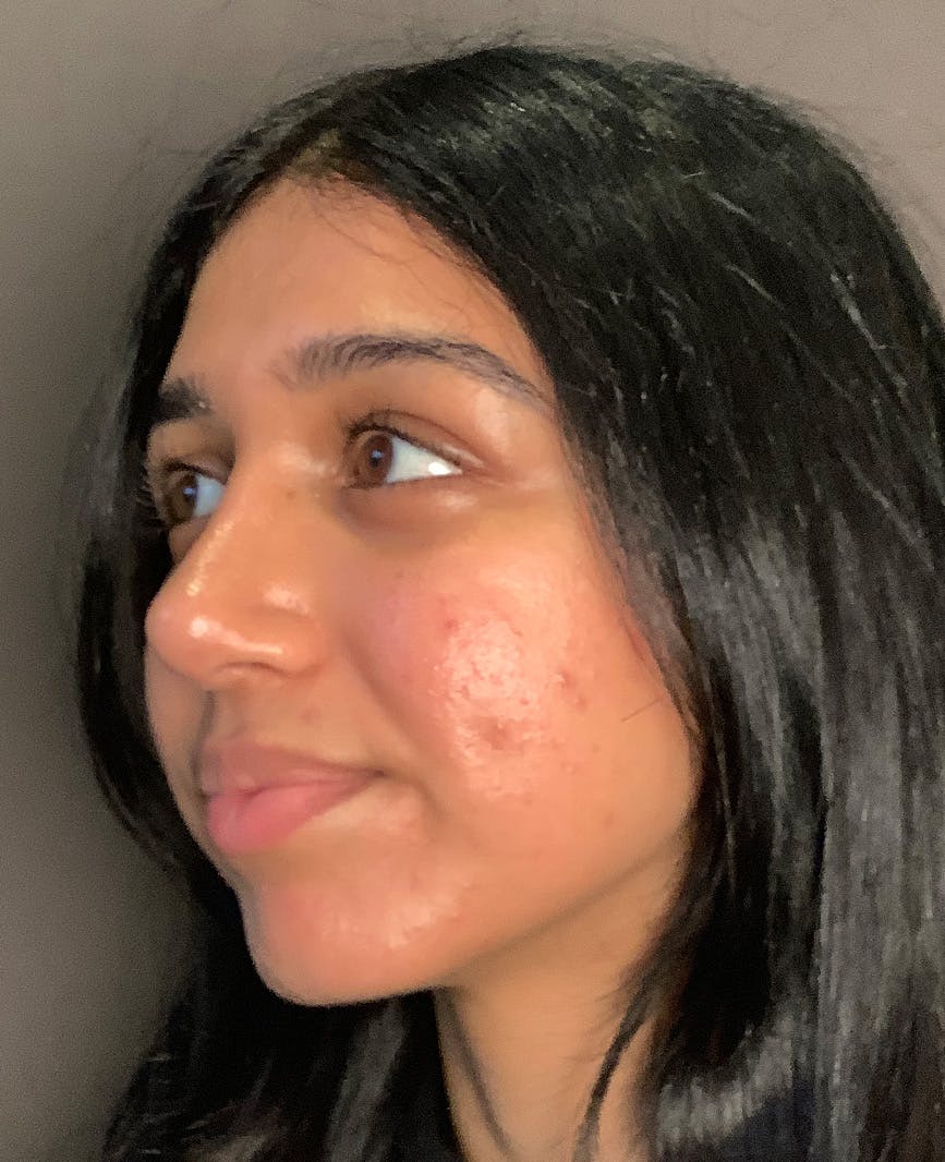 Rhinoplasty Before & After Gallery - Patient 342911 - Image 10