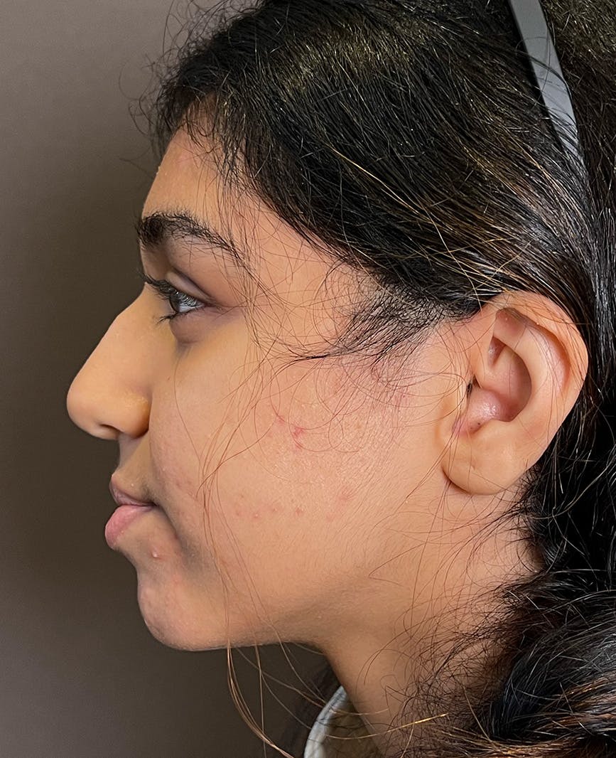 Rhinoplasty Before & After Gallery - Patient 342911 - Image 11