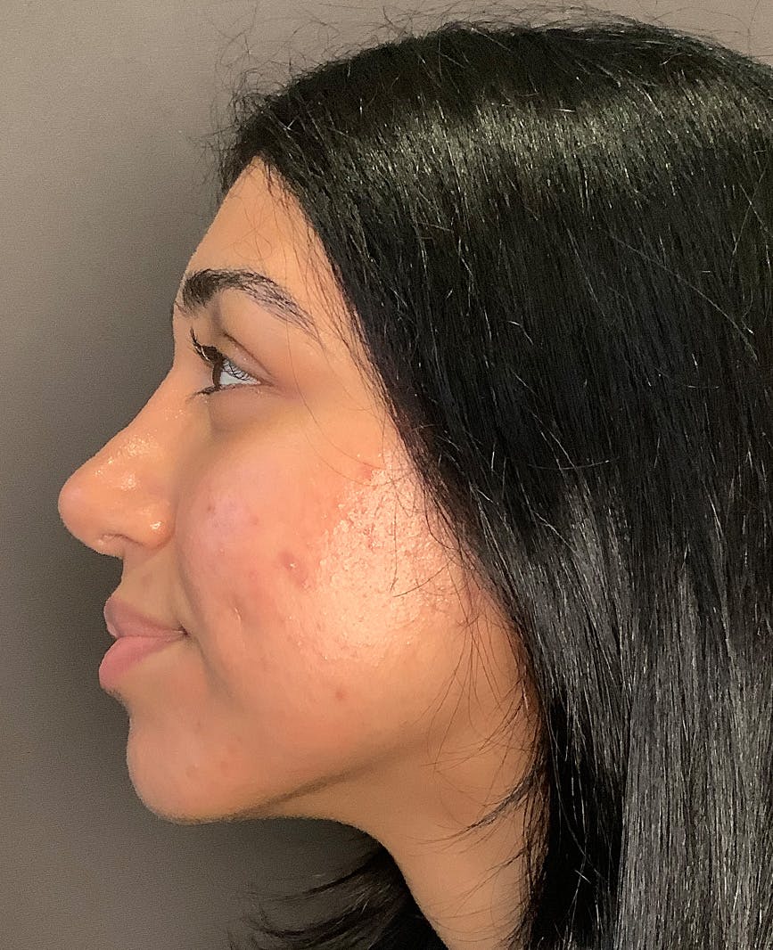 Rhinoplasty Before & After Gallery - Patient 342911 - Image 12