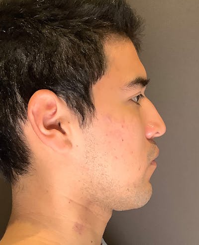 Rhinoplasty Before & After Gallery - Patient 314911 - Image 1