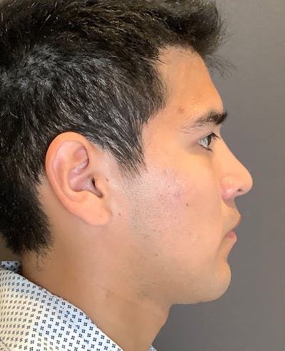 Rhinoplasty Before & After Gallery - Patient 314911 - Image 2