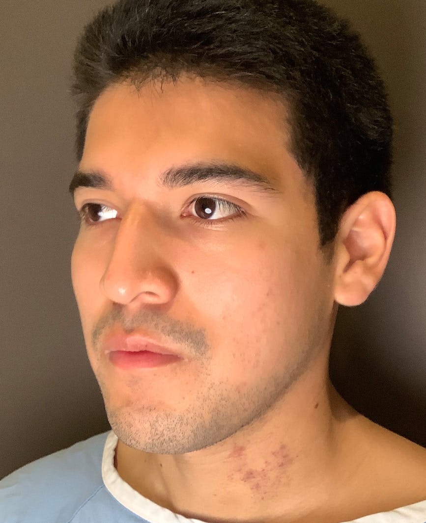 Rhinoplasty Before & After Gallery - Patient 314911 - Image 7