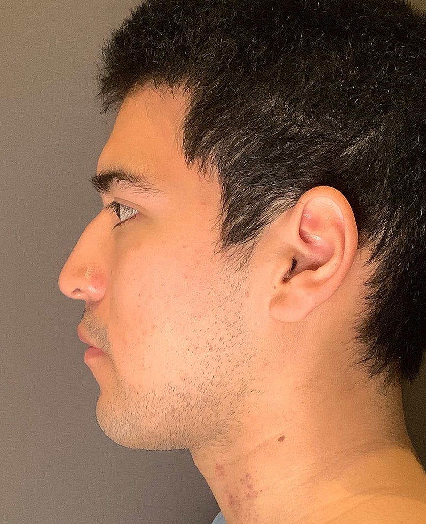 Rhinoplasty Before & After Gallery - Patient 314911 - Image 9