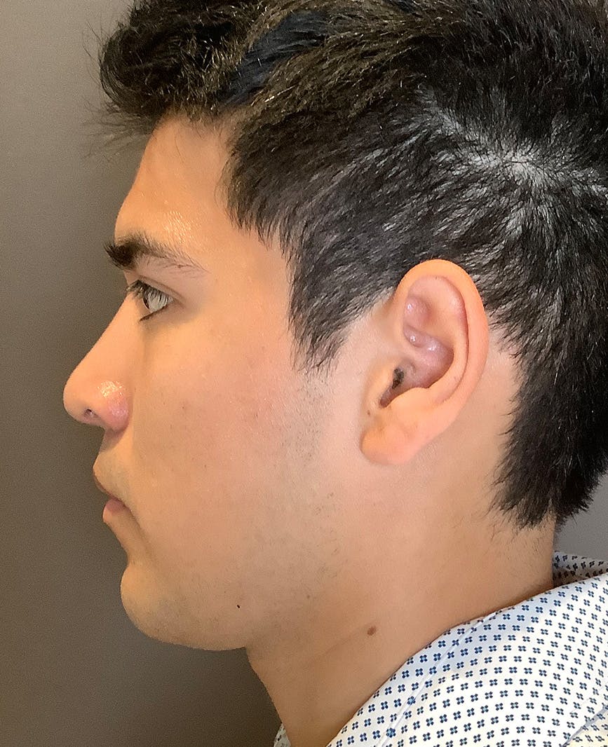 Rhinoplasty Before & After Gallery - Patient 314911 - Image 10