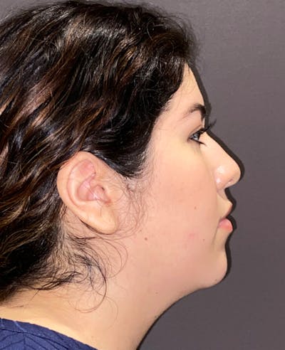 Rhinoplasty Before & After Gallery - Patient 273713 - Image 1