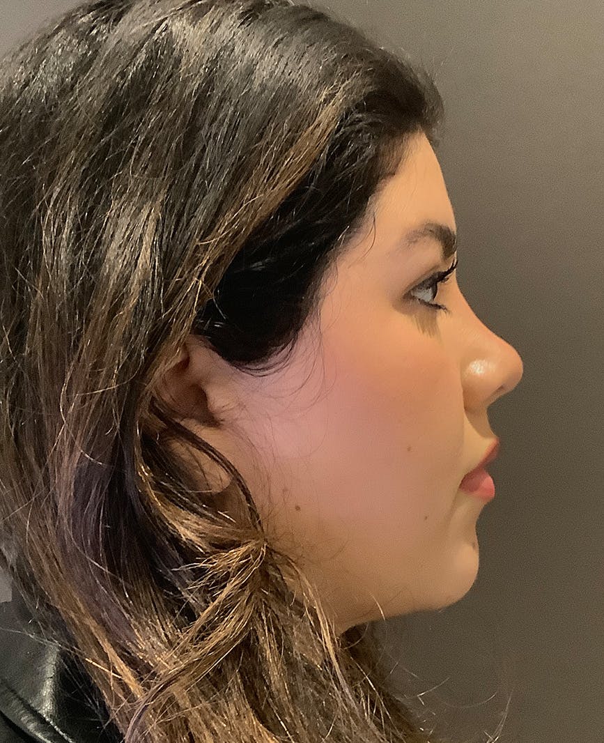 Rhinoplasty Before & After Gallery - Patient 273713 - Image 2