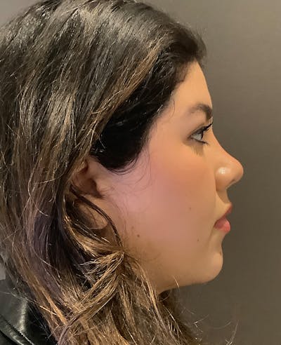Rhinoplasty Before & After Gallery - Patient 273713 - Image 2