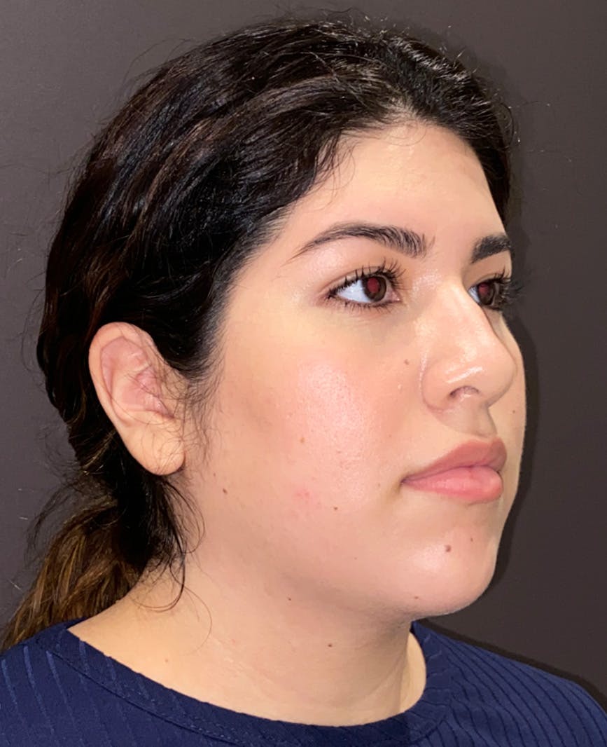 Rhinoplasty Before & After Gallery - Patient 273713 - Image 3