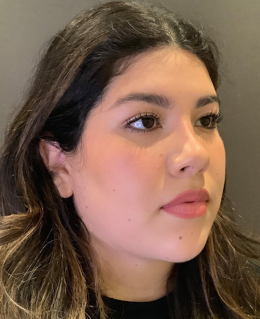 Rhinoplasty Before & After Gallery - Patient 273713 - Image 4