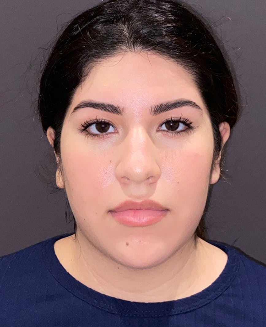 Rhinoplasty Before & After Gallery - Patient 273713 - Image 5