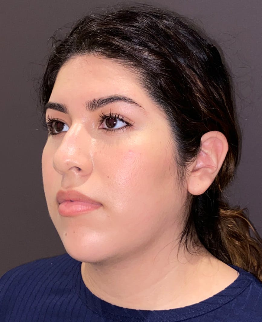 Rhinoplasty Before & After Gallery - Patient 273713 - Image 7