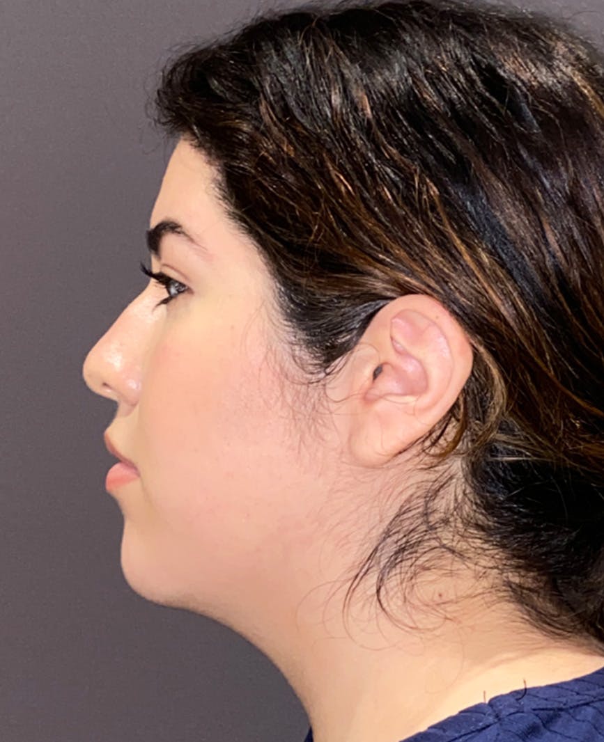 Rhinoplasty Before & After Gallery - Patient 273713 - Image 9