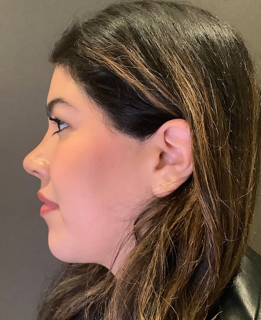 Rhinoplasty Before & After Gallery - Patient 273713 - Image 10