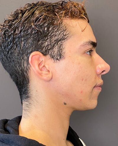 Chin Augmentation Before & After Gallery - Patient 254860 - Image 1