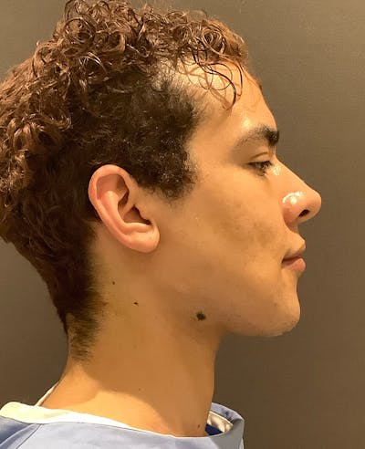 Chin Augmentation Before & After Gallery - Patient 254860 - Image 2