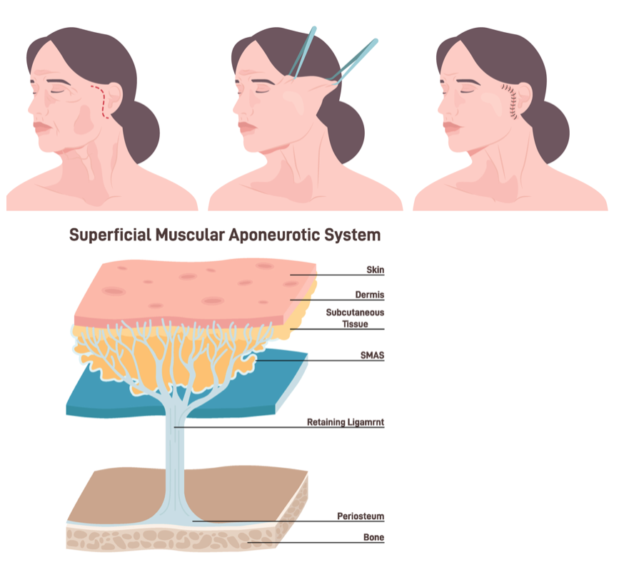 SMAS facelift diagram