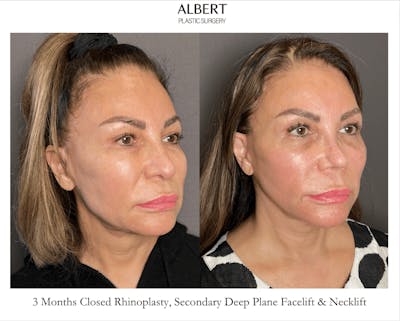 Facelifts / Necklift Before & After Gallery - Patient 359862 - Image 1