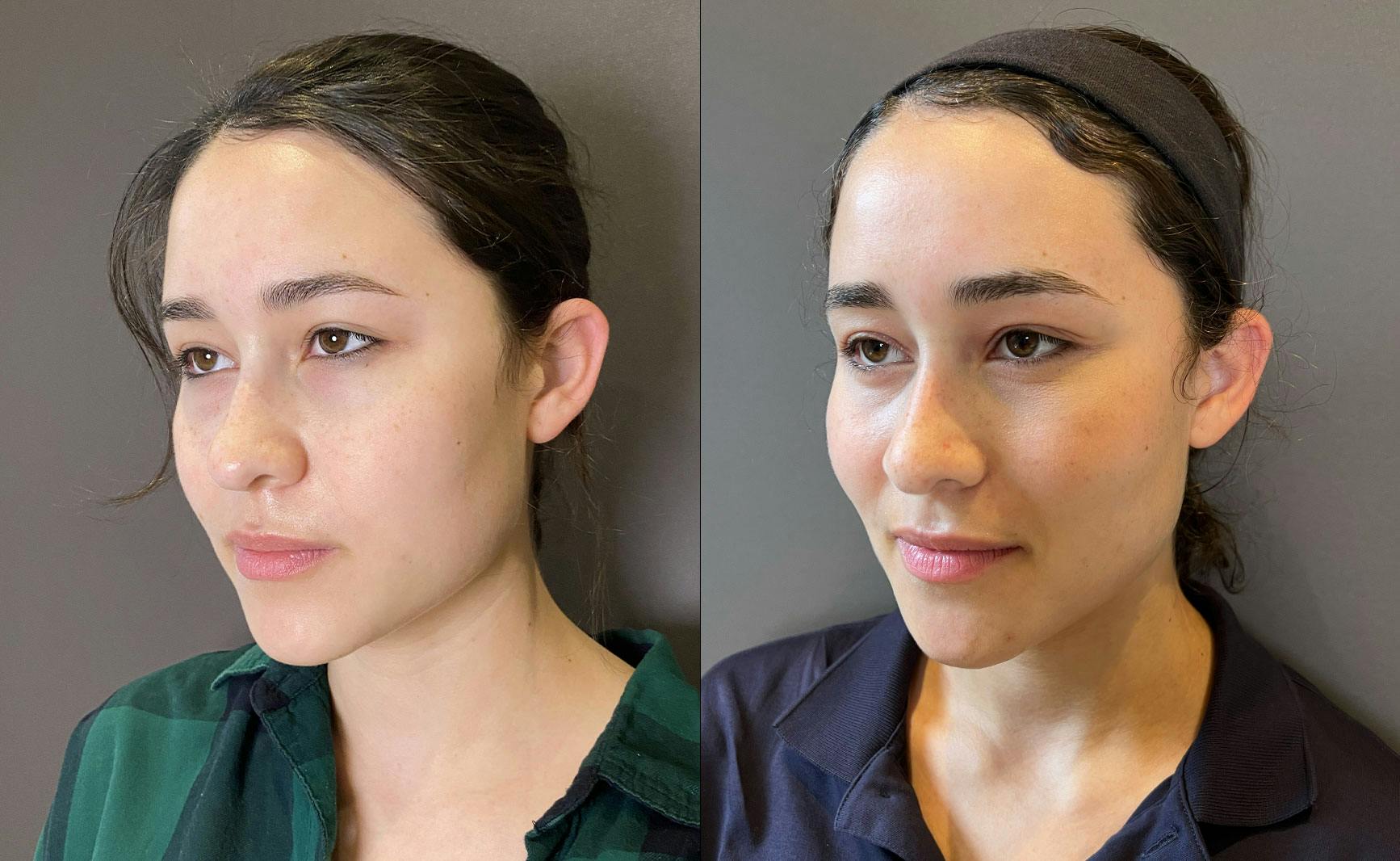 Eyelid Surgery Before & After Gallery - Patient 339497 - Image 2