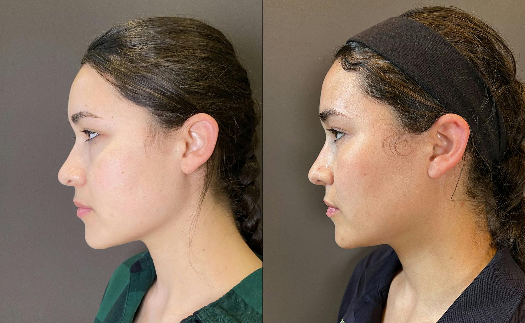 Eyelid Surgery Before & After Gallery - Patient 339497 - Image 3