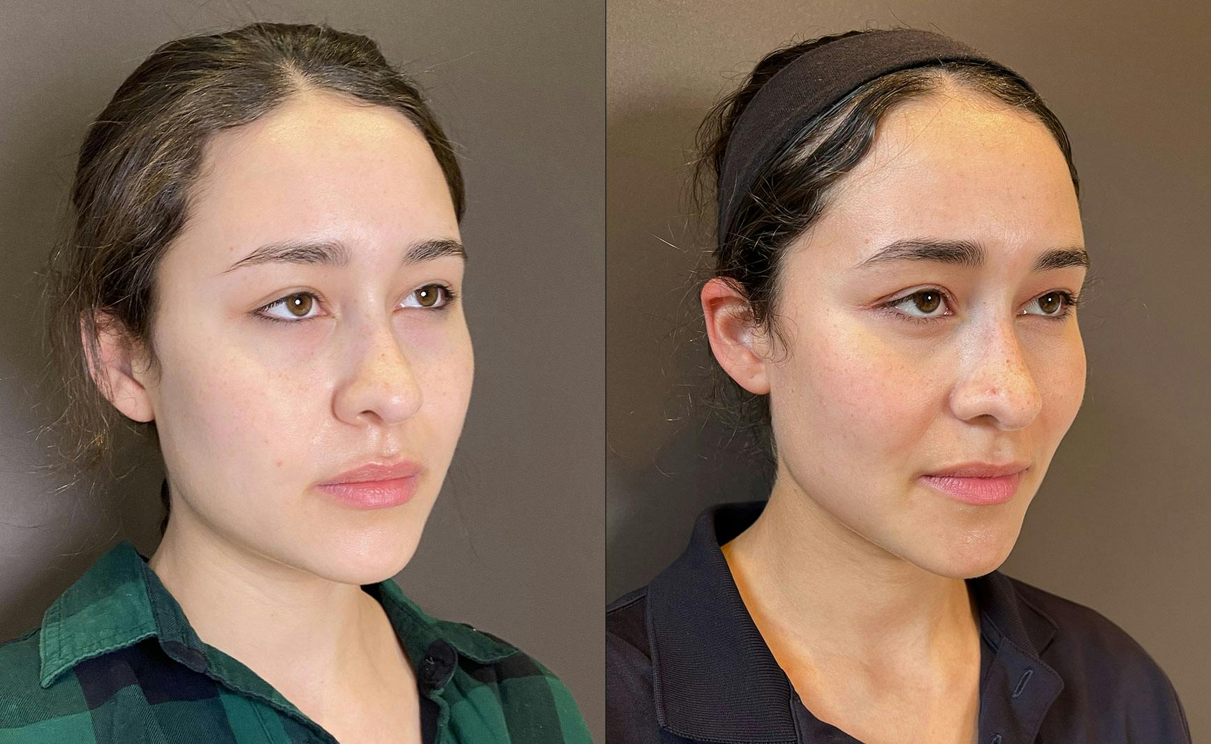 Eyelid Surgery Before & After Gallery - Patient 339497 - Image 5