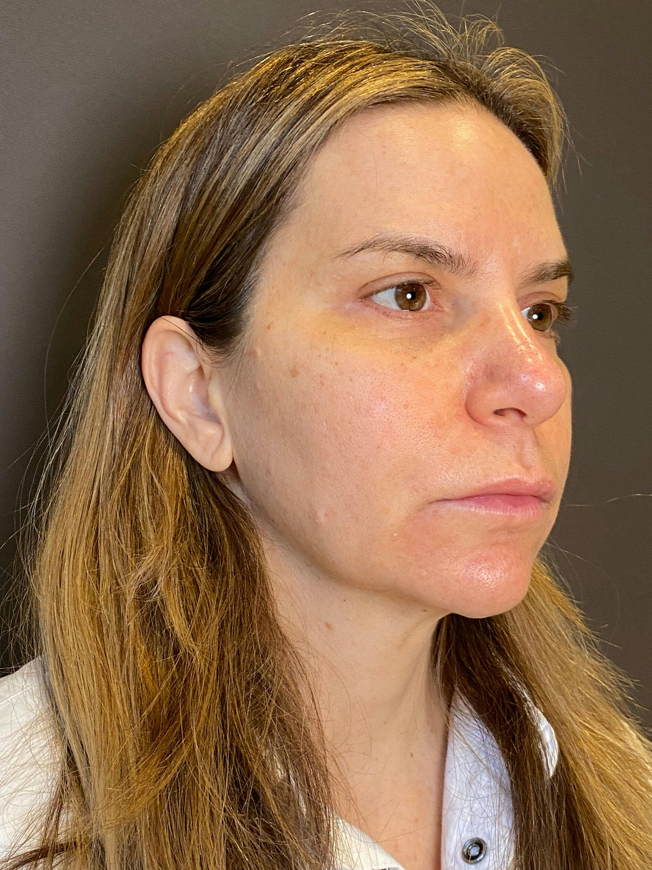 Facelifts / Necklift Before & After Gallery - Patient 290459 - Image 1