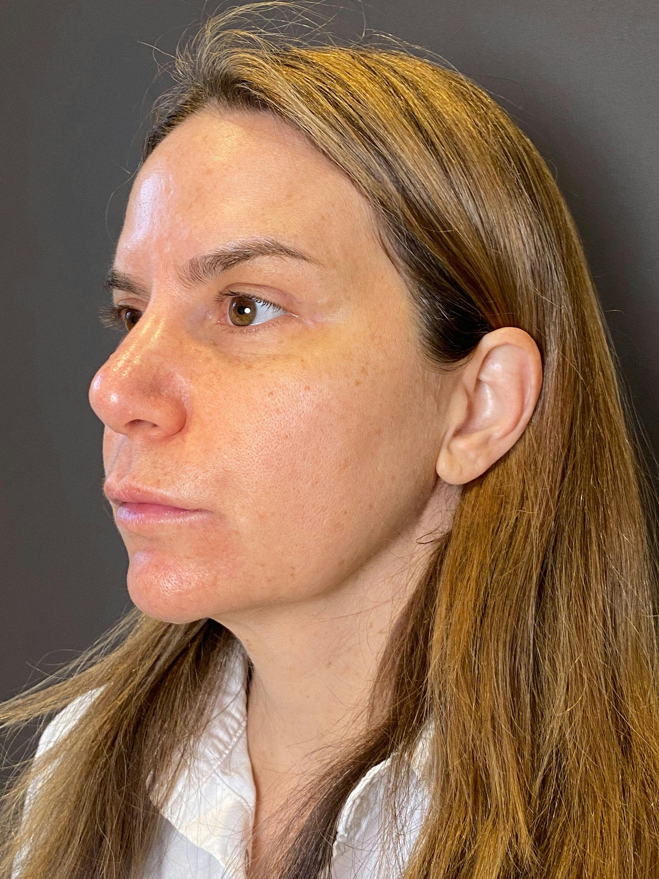 Facelifts / Necklift Before & After Gallery - Patient 290459 - Image 5