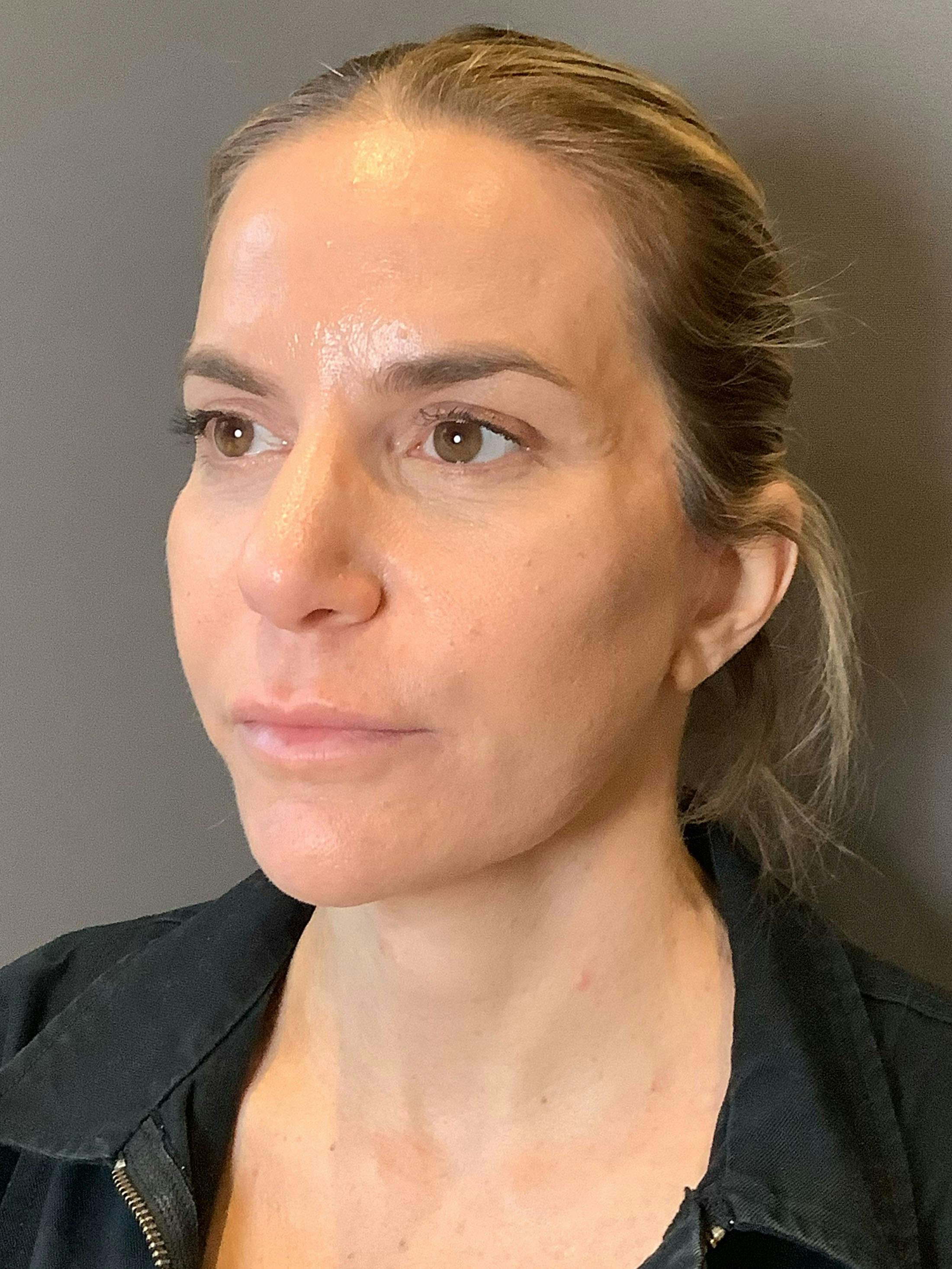Facelifts / Necklift Before & After Gallery - Patient 290459 - Image 6