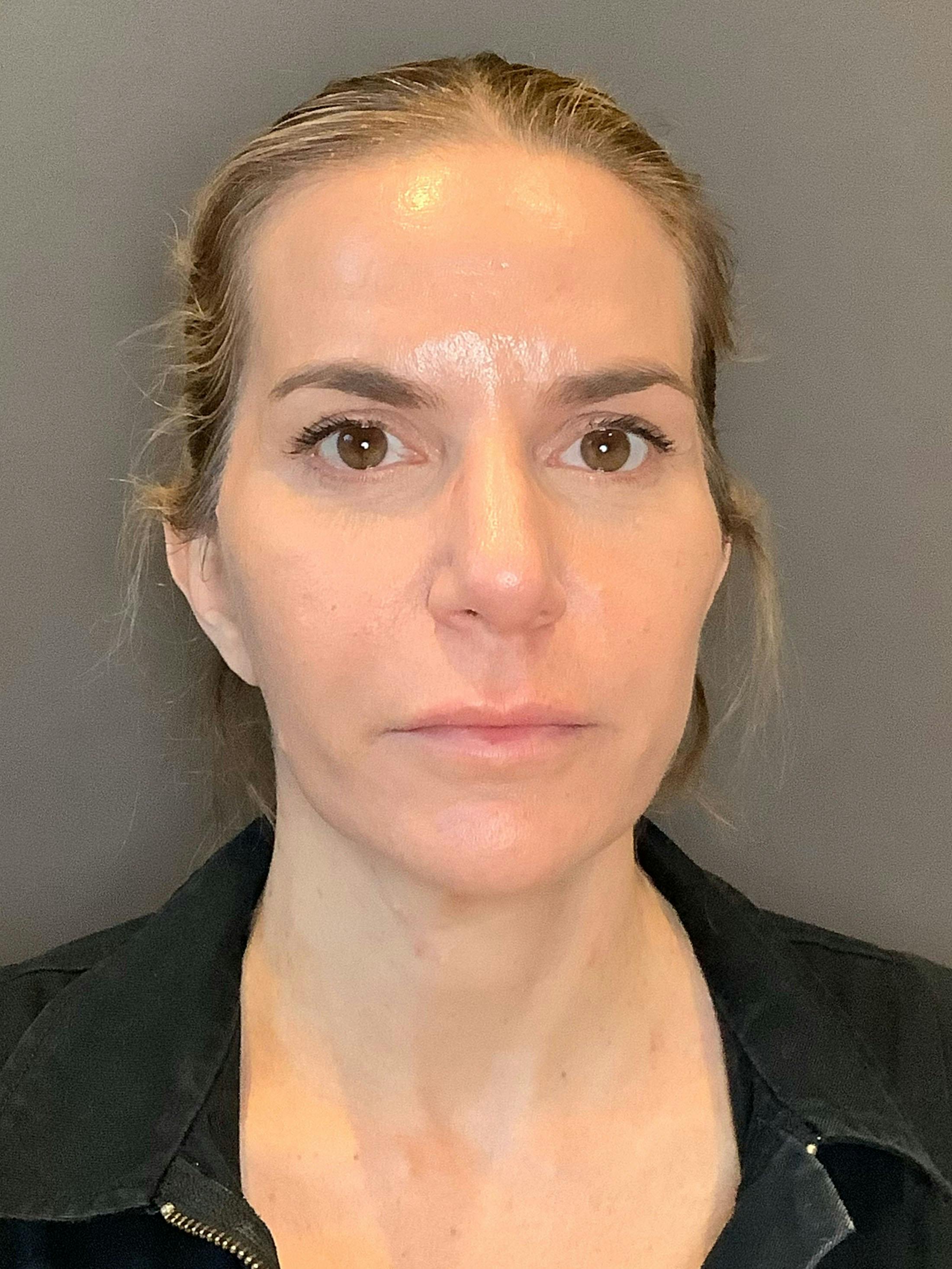 Facelifts / Necklift Before & After Gallery - Patient 290459 - Image 4