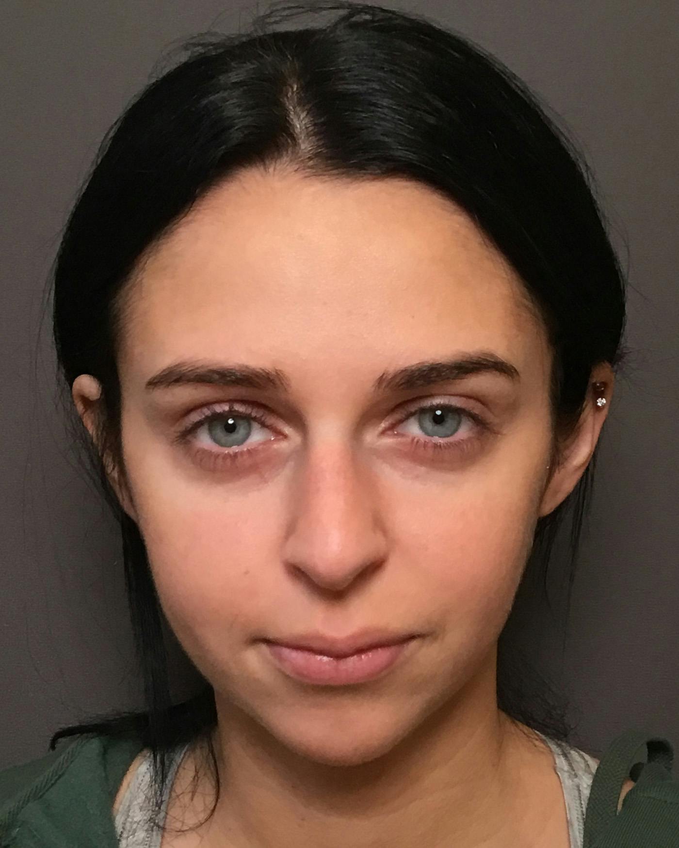 Rhinoplasty Before & After Gallery - Patient 265222 - Image 5