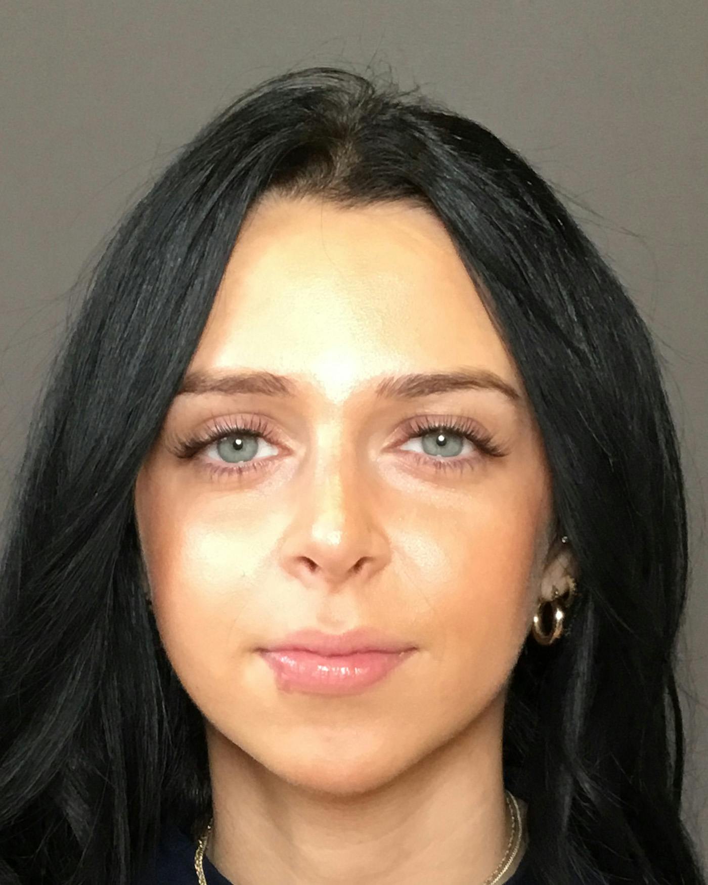Rhinoplasty Before & After Gallery - Patient 265222 - Image 6