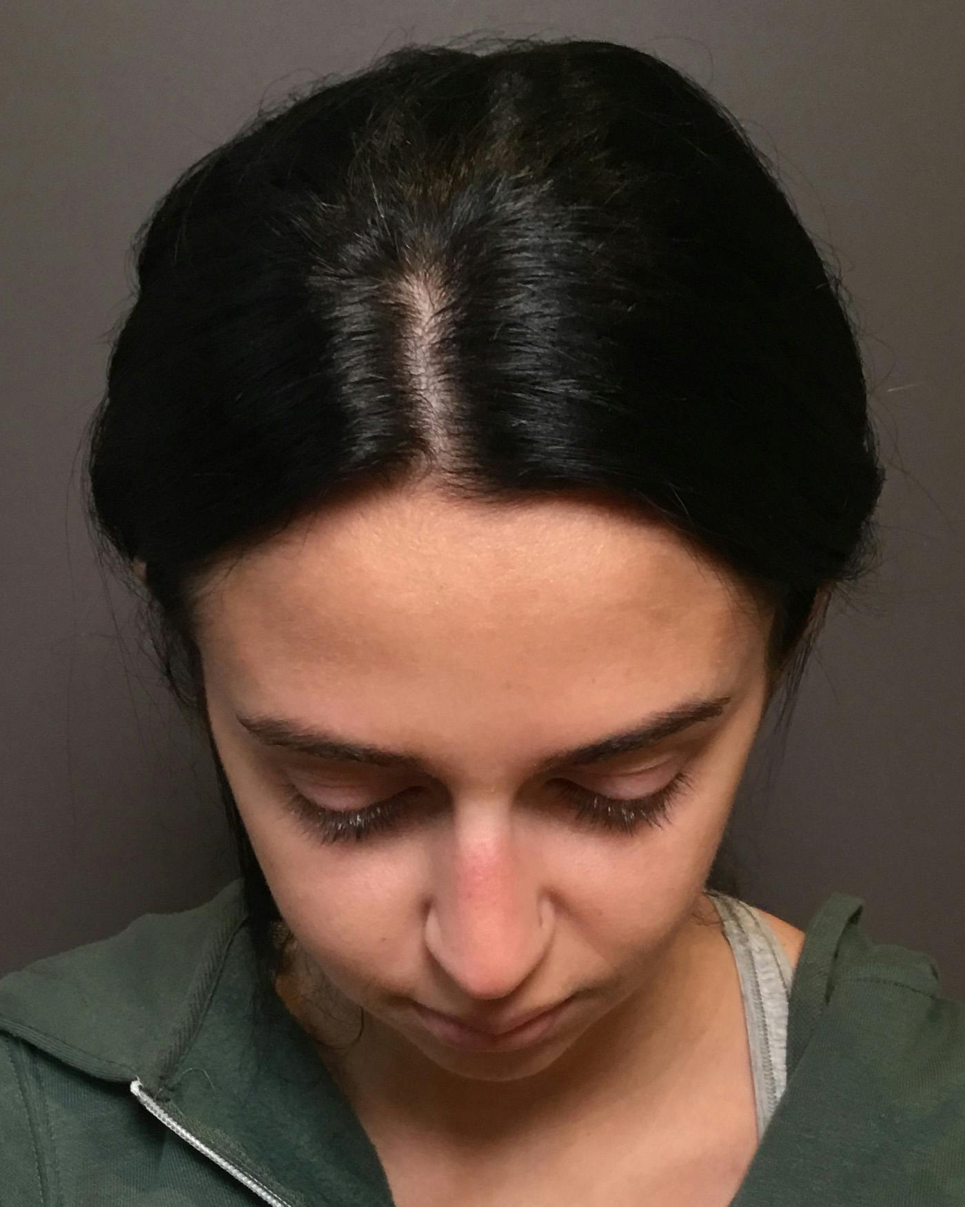Rhinoplasty Before & After Gallery - Patient 265222 - Image 7