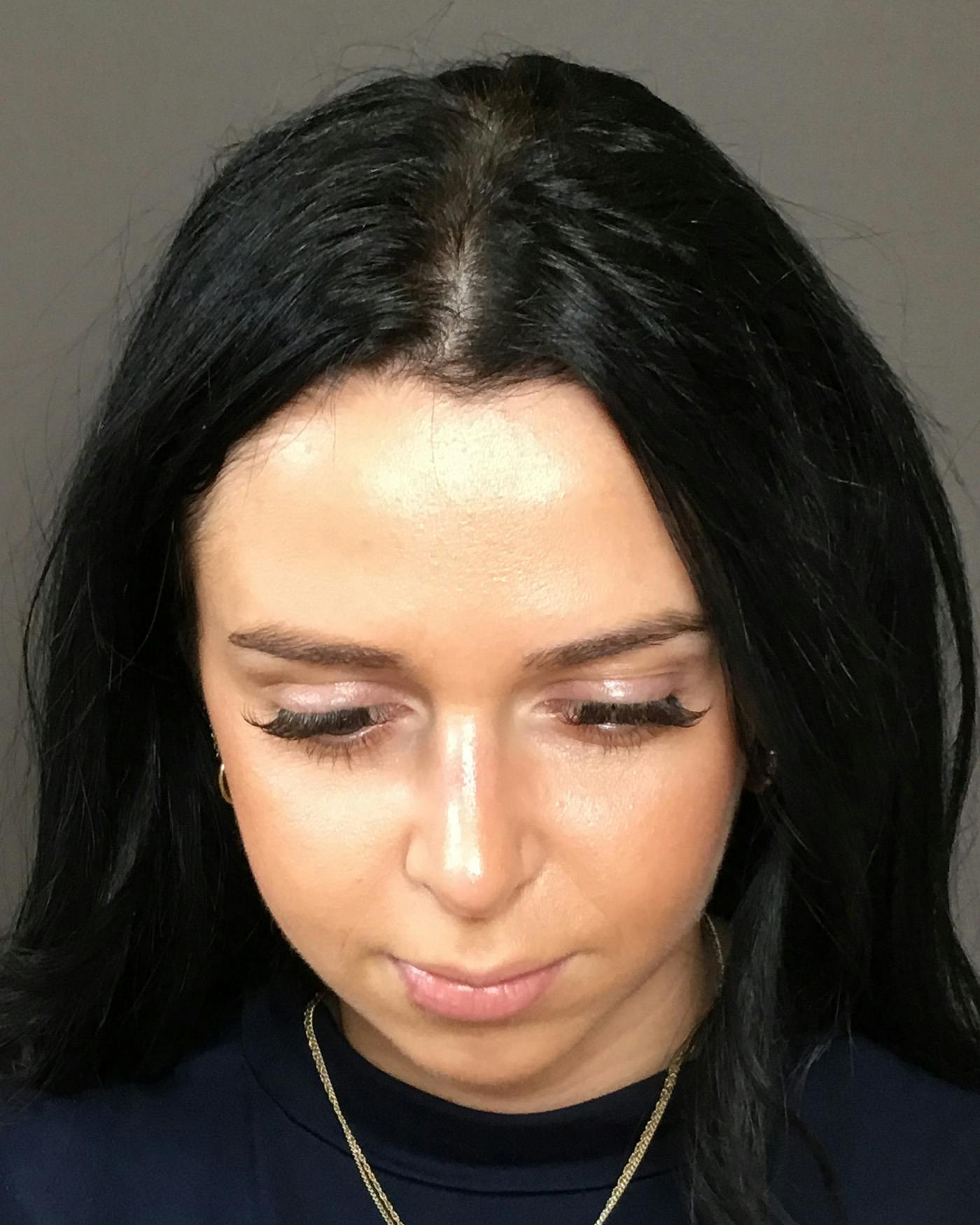 Rhinoplasty Before & After Gallery - Patient 265222 - Image 8