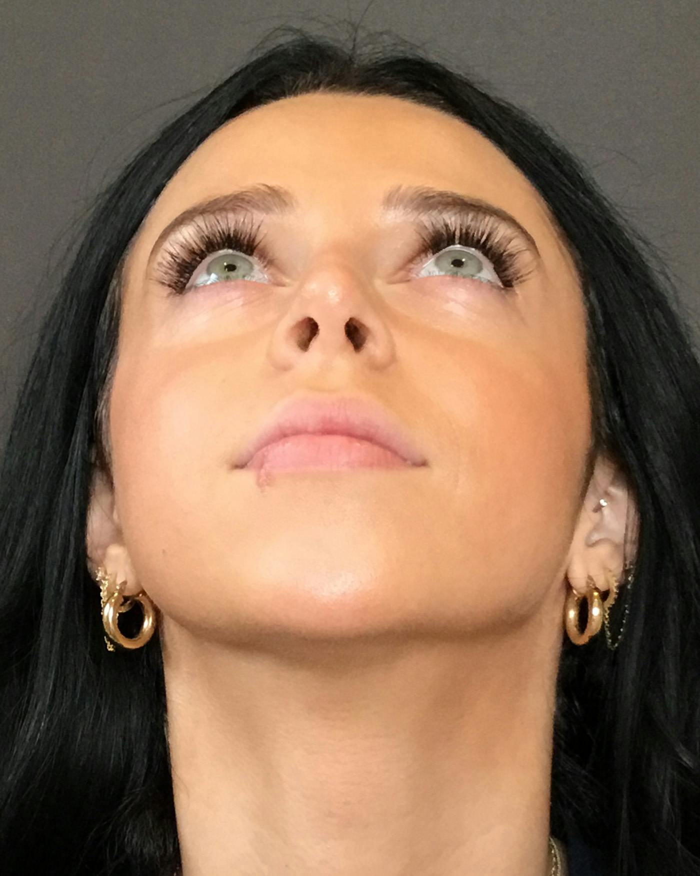 Rhinoplasty Before & After Gallery - Patient 265222 - Image 14
